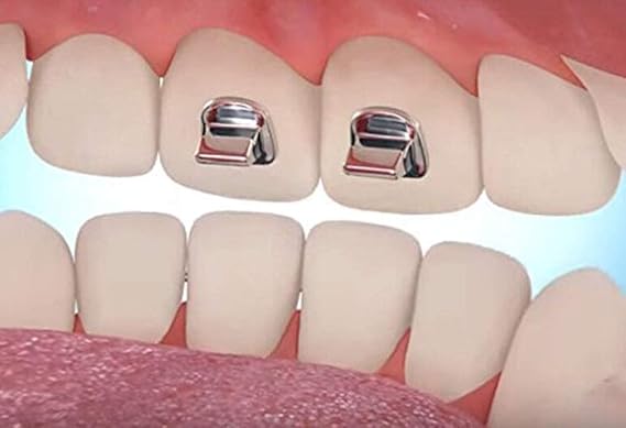 10 Pcs SmileTech Dental Bite Turbos Orthodontic Materials